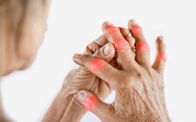 Arthritis: Understanding the Condition and How Physiotherapy Can Help